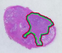 Image:Tumor_marked(v31)1x_2807_67_0.jpg