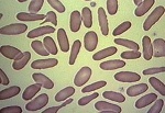 Red blood cells - elliptocytosis